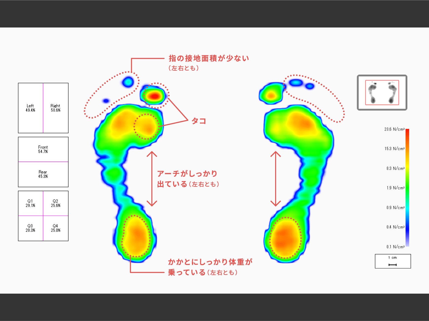 為末 大さん 足底圧分析結果画像