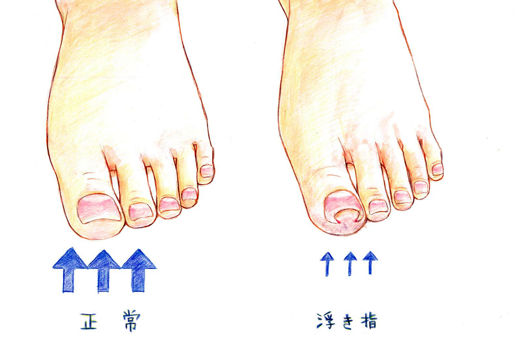 巻き爪 陥入爪の原因とは 正しい知識で対策しましょう コラム 足のちえぶくろ ケアソク Care Soku 株式会社山忠