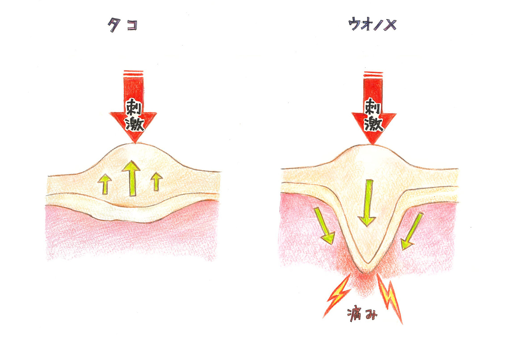 気になるタコ ウオノメは足裏 足指 できる場所から原因を探る コラム 足のちえぶくろ ケアソク Care Soku 株式会社山忠 気になるタコ ウオノメは足裏 足指 できる場所から原因を探る コラム 足のちえぶくろ ケアソク Care Soku 株式会社山忠