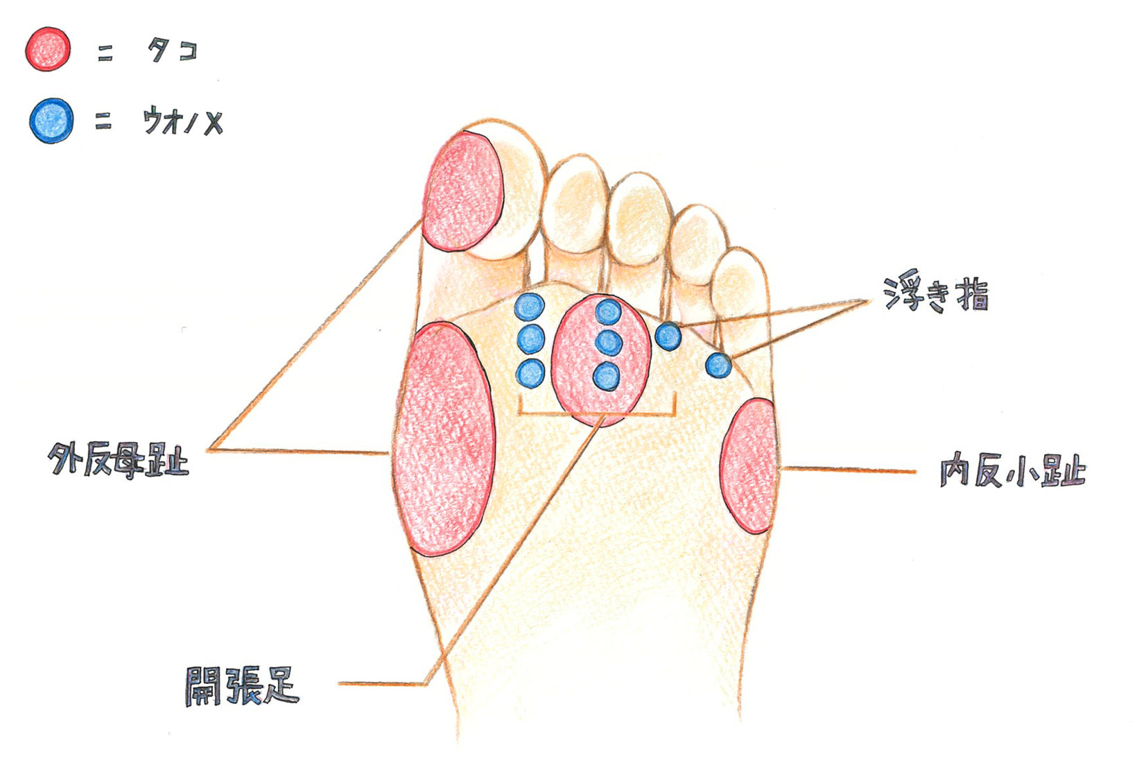 気になるタコ ウオノメは足裏 足指 できる場所から原因を探る コラム 足のちえぶくろ ケアソク Care Soku 株式会社山忠