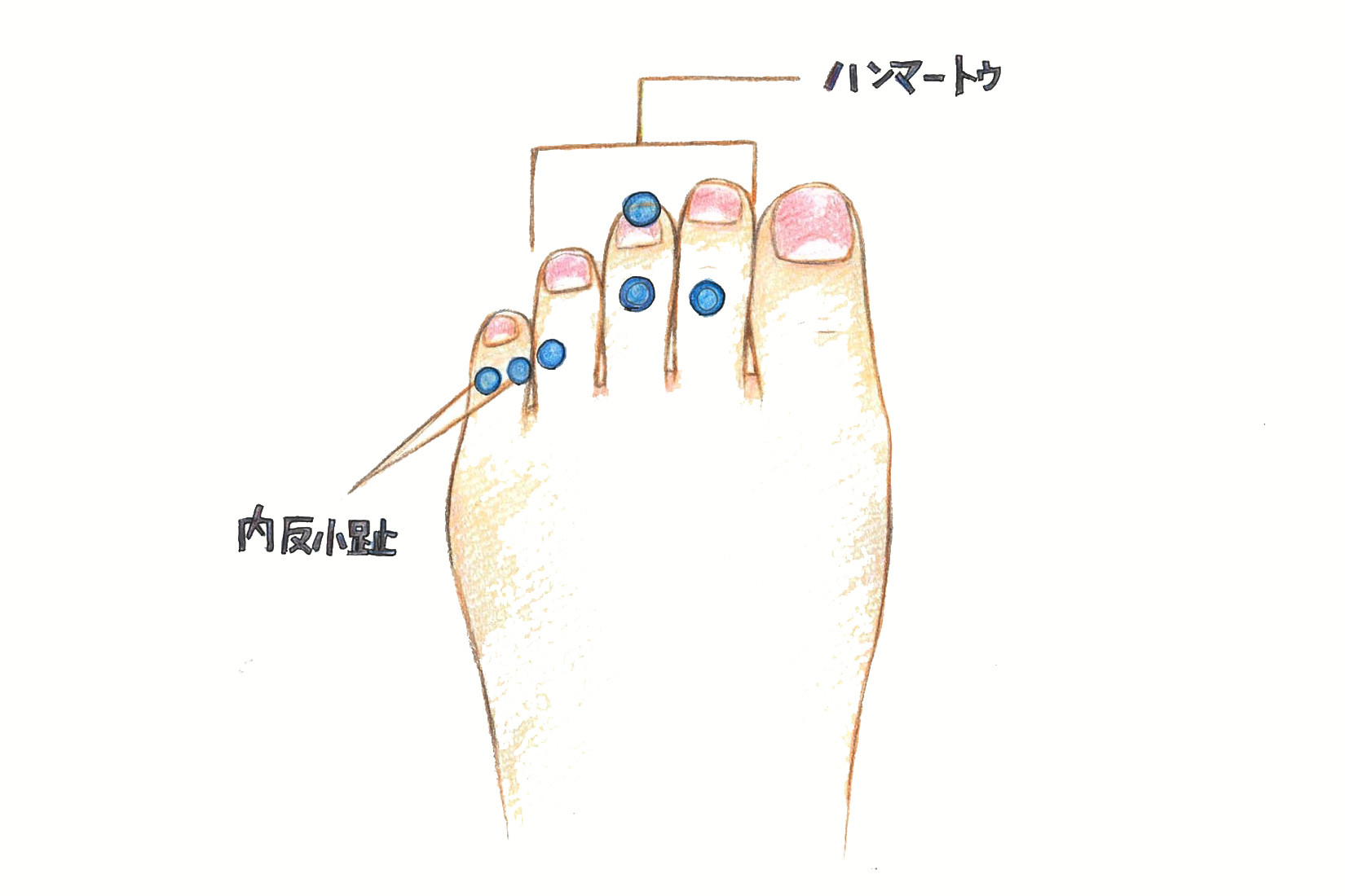 気になるタコ ウオノメは足裏 足指 できる場所から原因を探る コラム 足のちえぶくろ ケアソク Care Soku 株式会社山忠