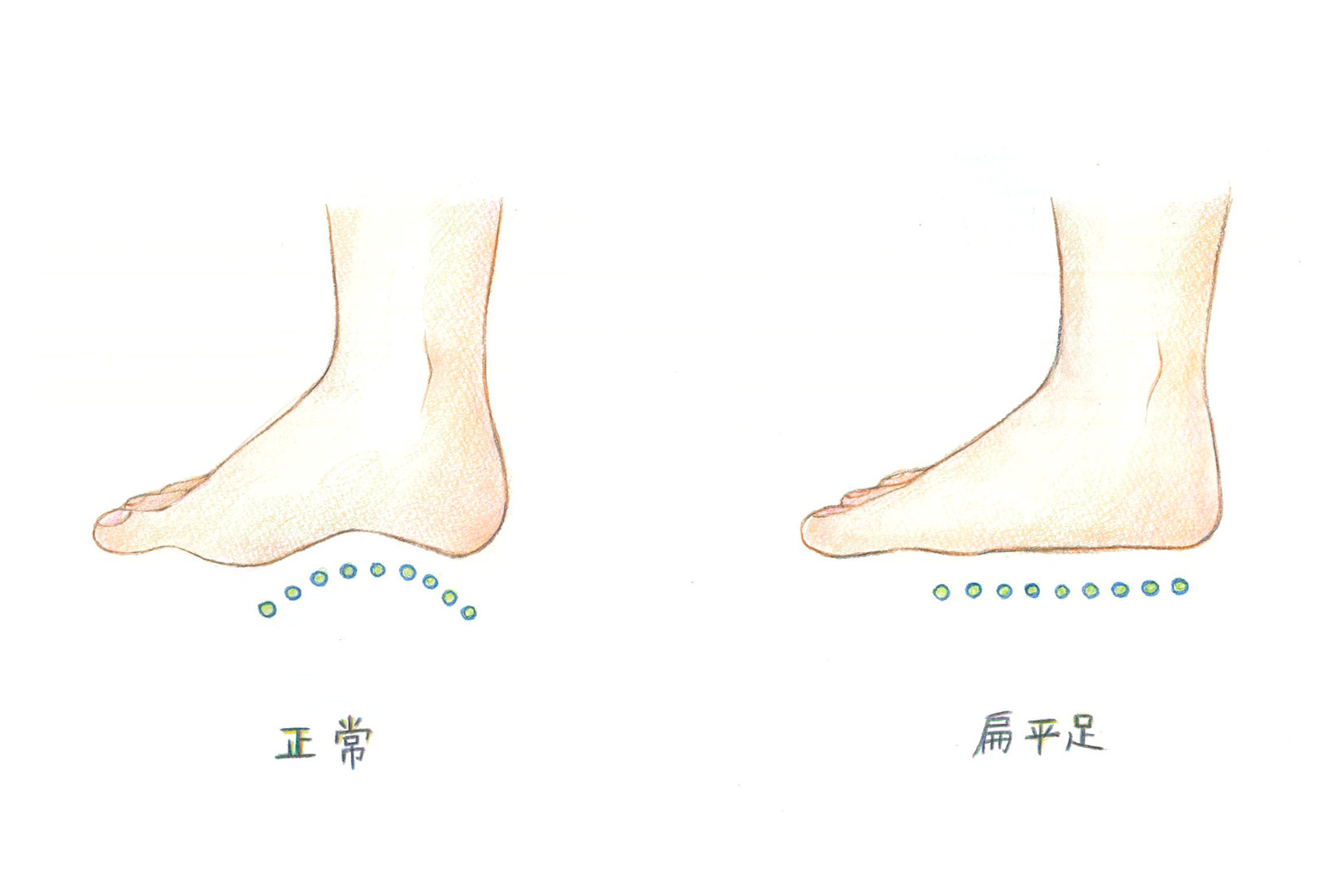 扁平足ってどんな足？靴下選びに役に立つ基礎知識