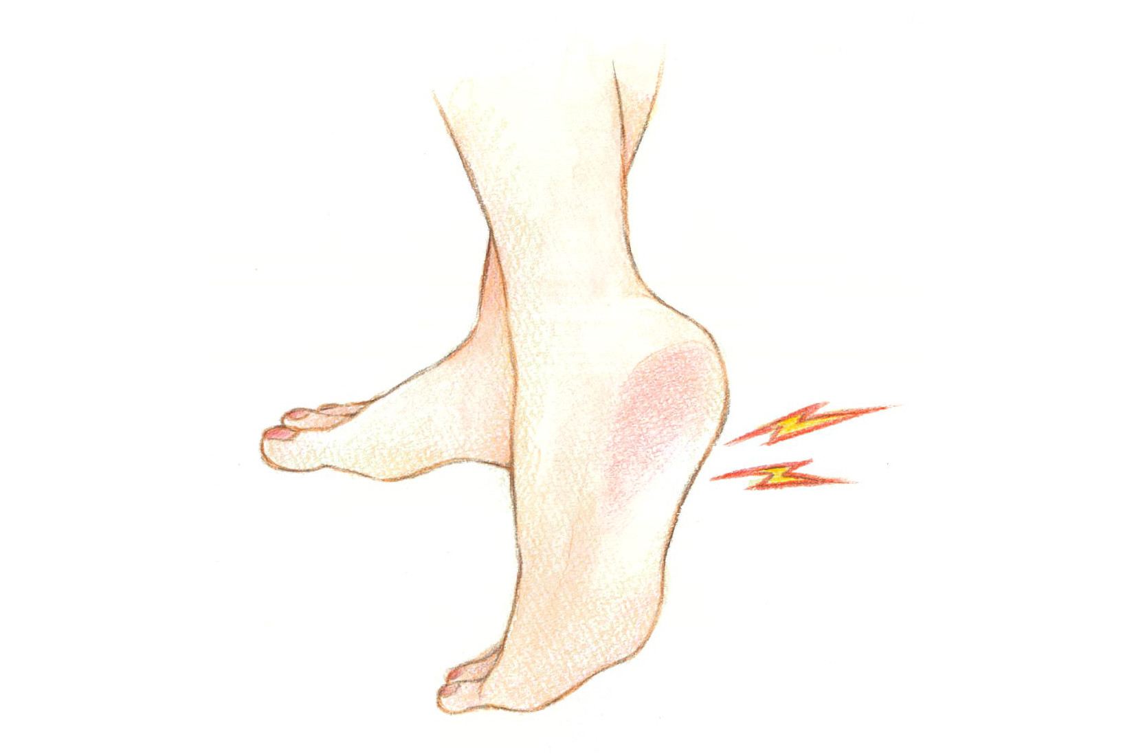 足底筋膜炎と靴下は関係ある？概要と症状を解説