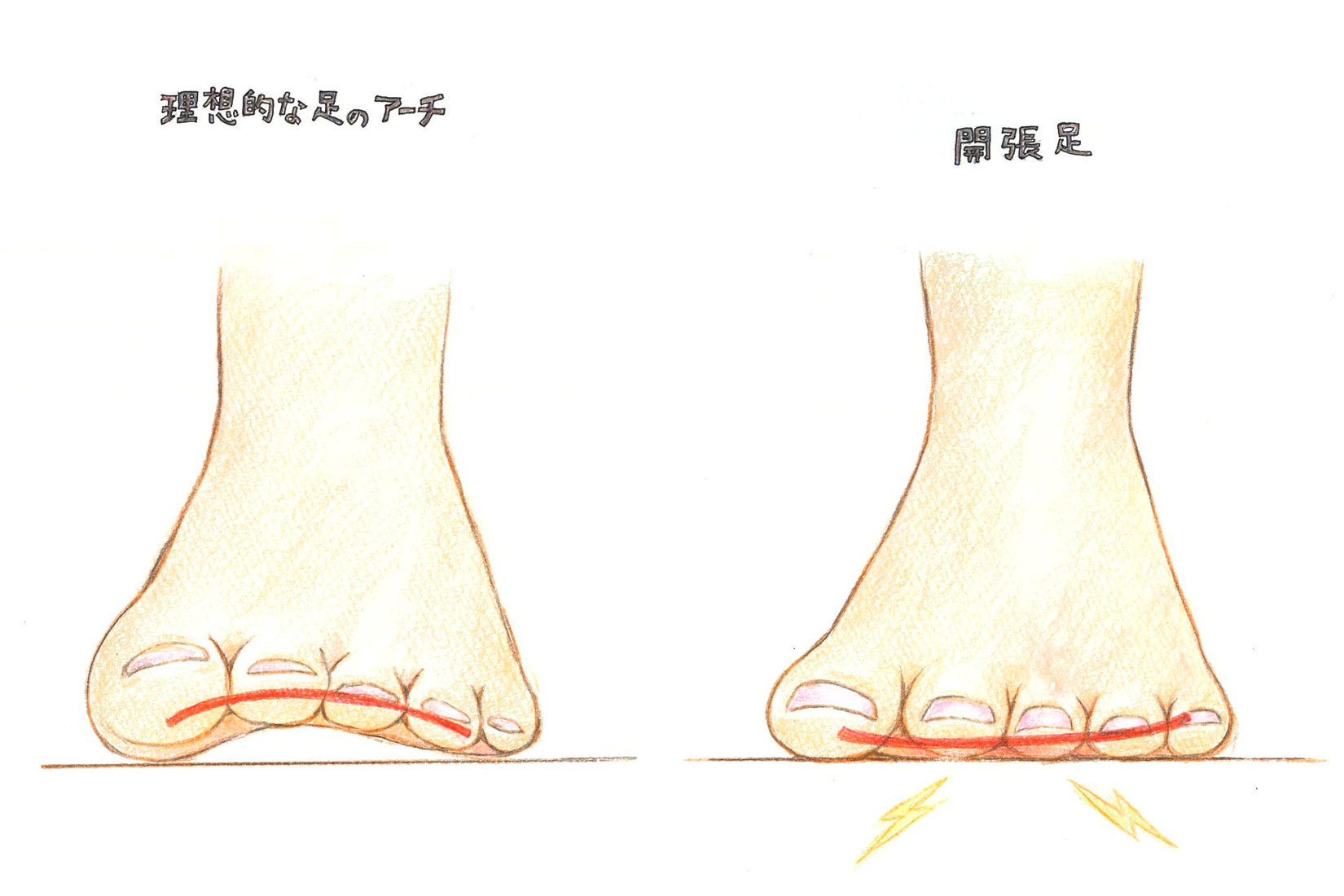 中足骨骨頭痛で足裏が痛む 靴下の選び方と改善方法を解説 コラム 足のちえぶくろ ケアソク Care Soku 株式会社山忠