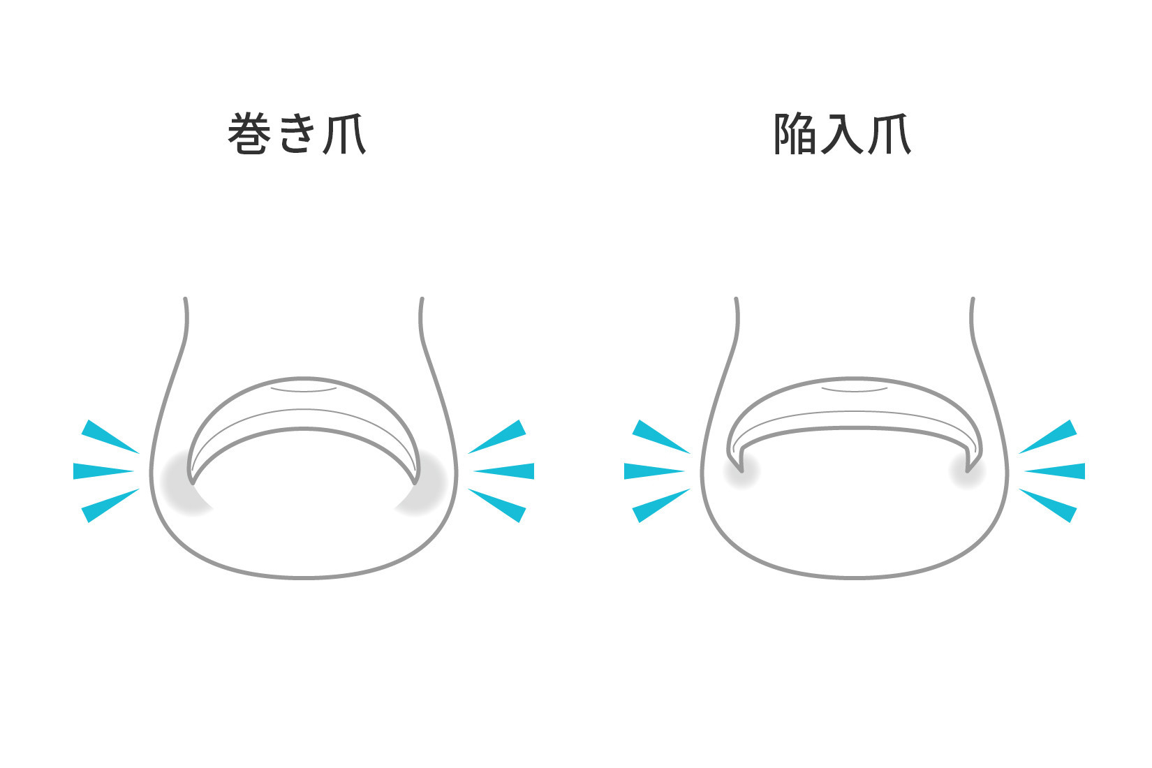 巻き爪と陥入爪