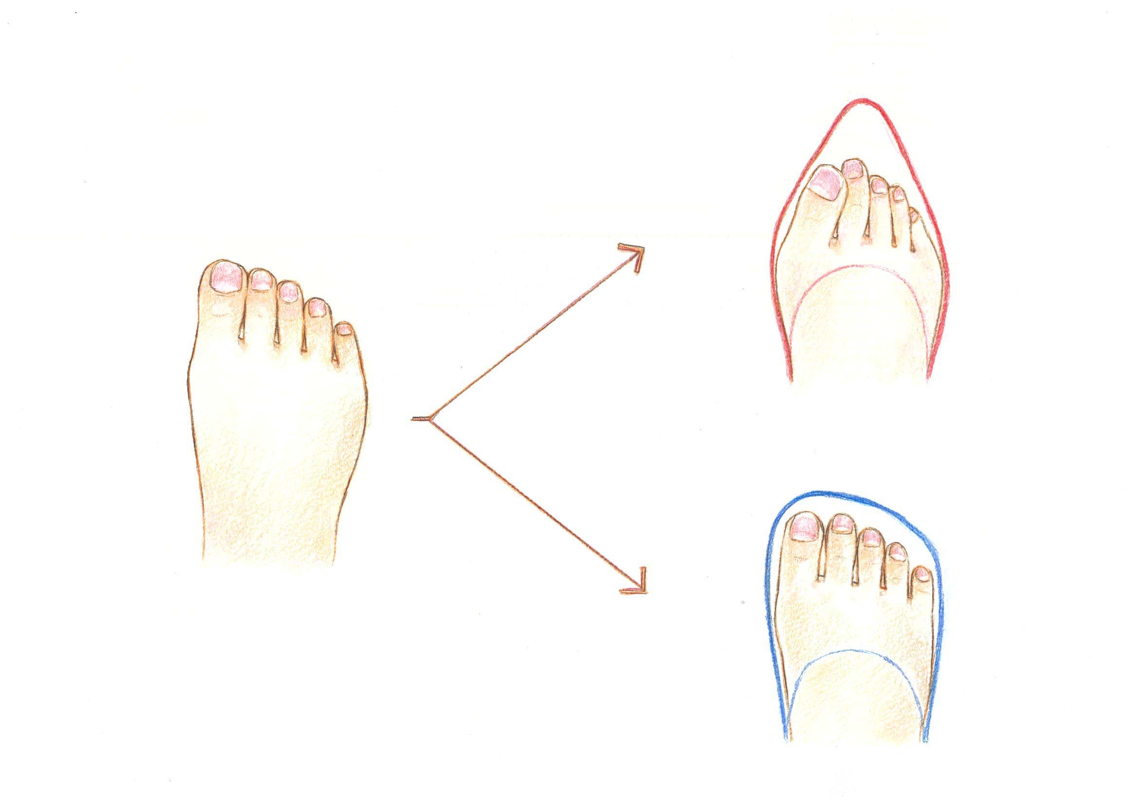 内反小趾と靴の関係