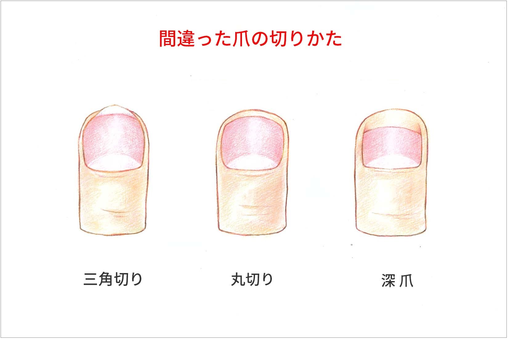 深爪などの間違った爪切り