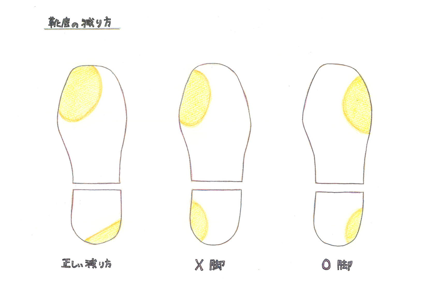 靴底の減り方