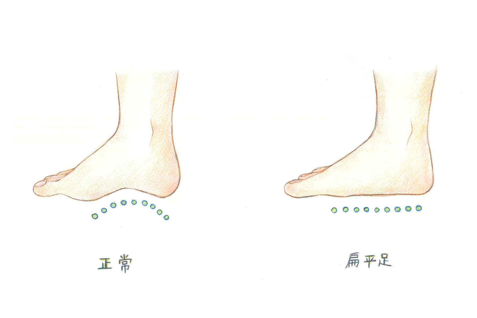 扁平足とは？あなたの足は大丈夫？