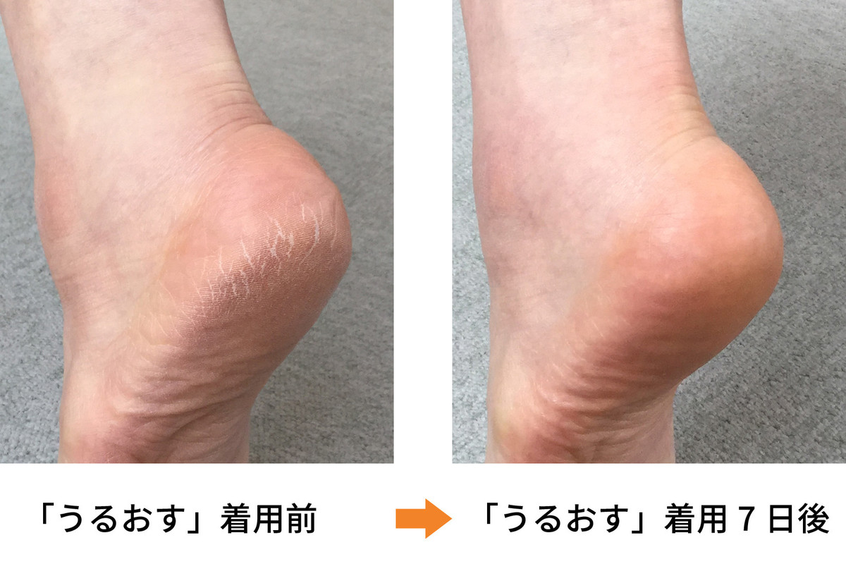 実証 ガサガサかかとも 履くだけ でツルツルに 夏直前でも間に合うお手軽かかとケアはこれだ コラム 足のちえぶくろ ケアソク Care Soku 株式会社山忠 実証 ガサガサかかとも 履くだけ でツルツルに 夏直前でも間に合うお手軽かかとケアはこれだ コラム 足のちえぶくろ ケアソク Care Soku 株式会社山忠